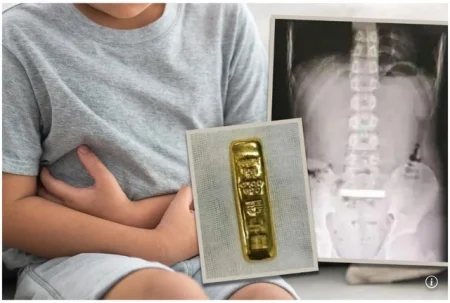 Cậu bé 11 tuổi nuốt thỏi vàng gần 3 lượng