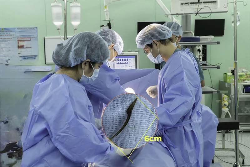 Can thiệp gắp xương cá dài 6cm đâm thủng ruột bệnh nhân&nbsp;